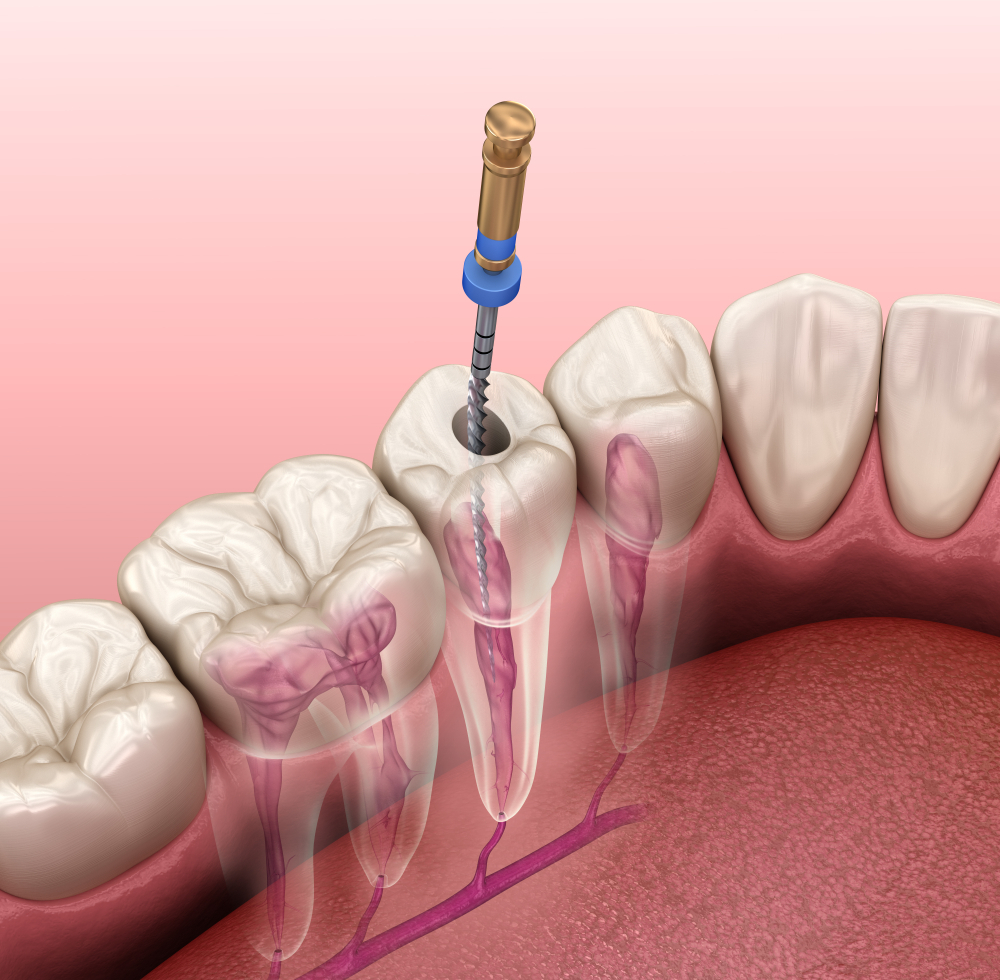 Root Canal Treatment in lucknow