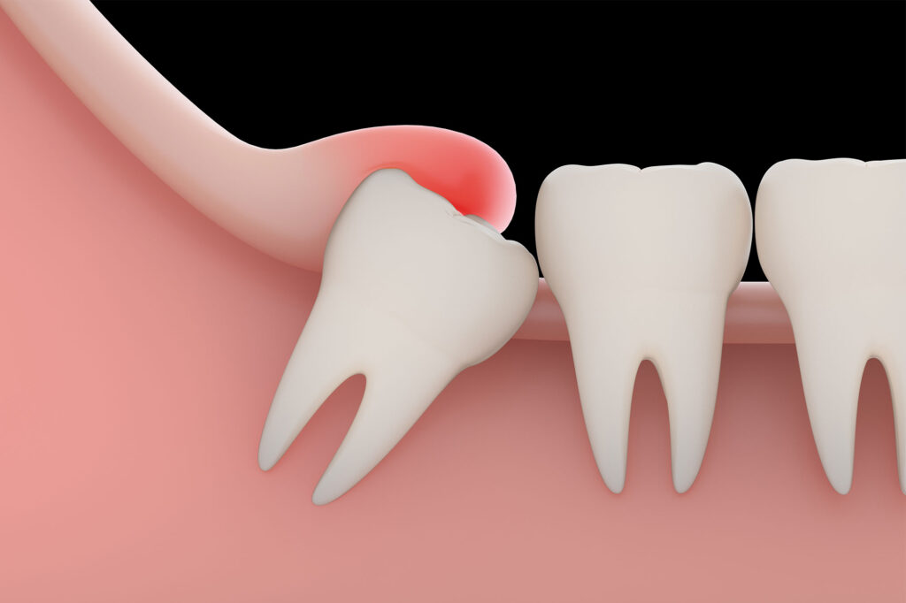 Tooth Extraction in Lucknow