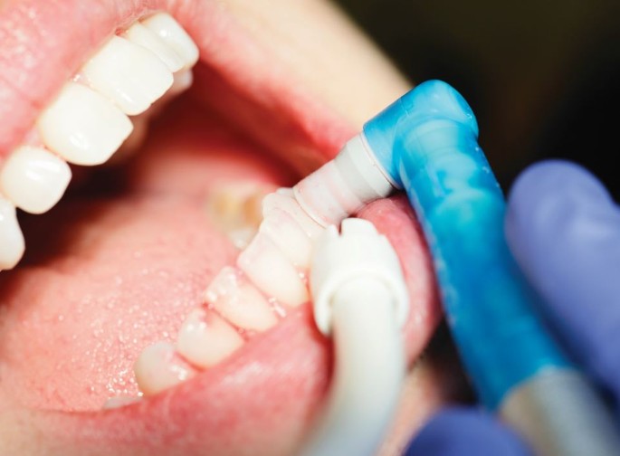Dental Prophylaxis or Teeth Cleaning in Lucknow