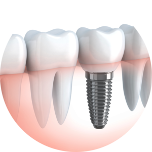 Dental Implants in Lucknow