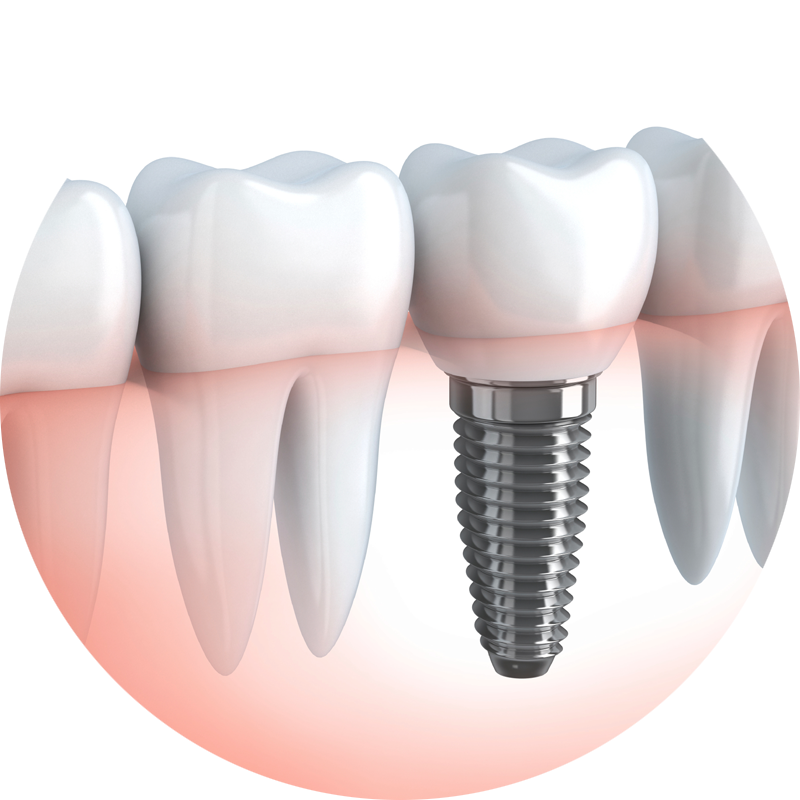 Dental Implants in Lucknow