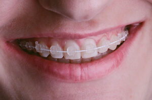Braces Treatment in Lucknow