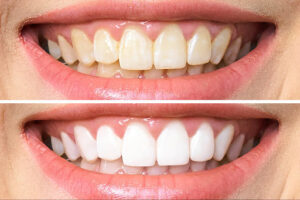 Teeth whitening in lucknow 