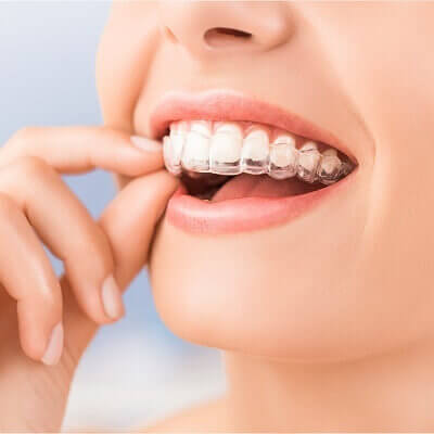 braces in lucknow , teeth straigthening lucknow
