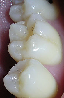 Understanding Dental Cavities & Its Causes