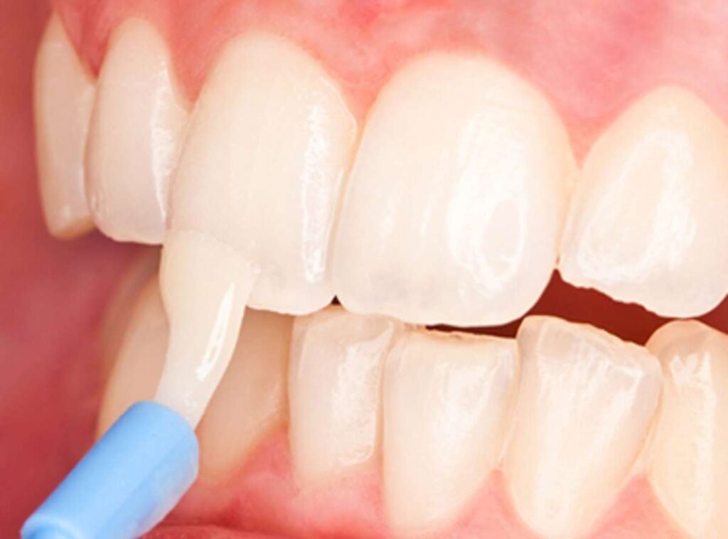 The Truth About Dental Flouride