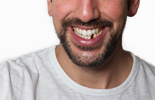 Missing teeth? Top 4 reasons necessary to replace it