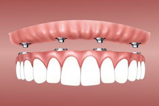 A GUIDE TO DENTURES: TYPES & MAINTAINING TIPS