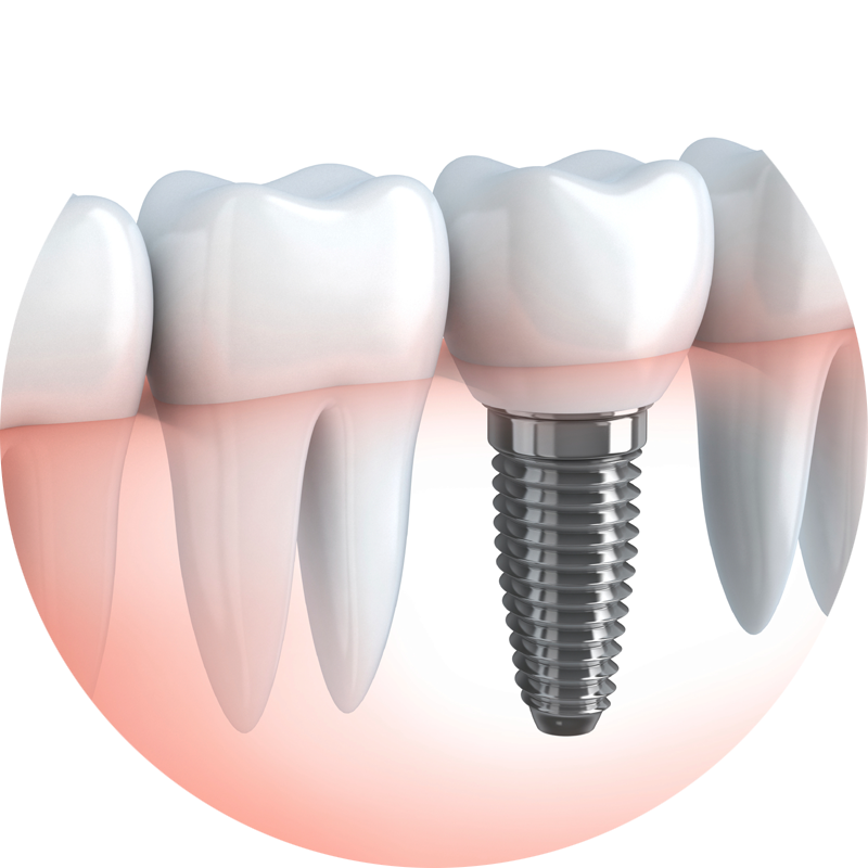 TOP BENEFITS OF CHOOSING DENTAL IMPLANTS?