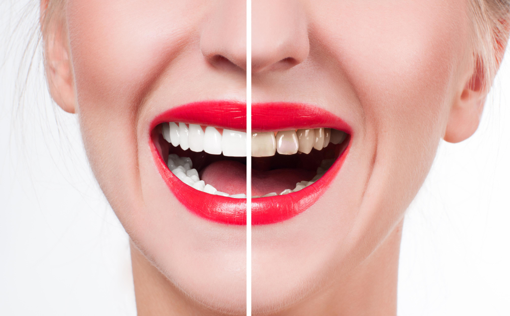 Is teeth whitening safe and permanent solution to enhance your smile?