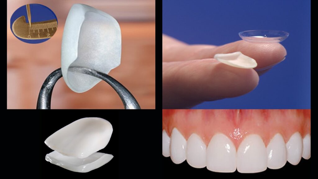 The Dental Veneer Procedure (step by step)