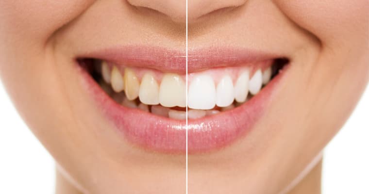 How a Smile Makeover can change your life?