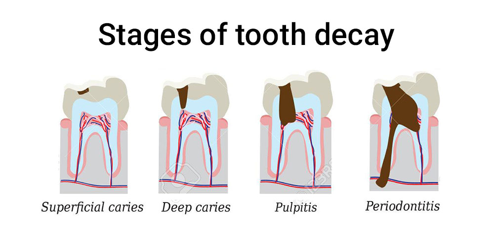 THE 5 STAGES OF TOOTH DECAY